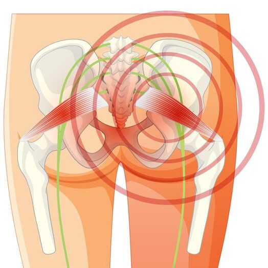 Užspaustas sėdimasis nervas